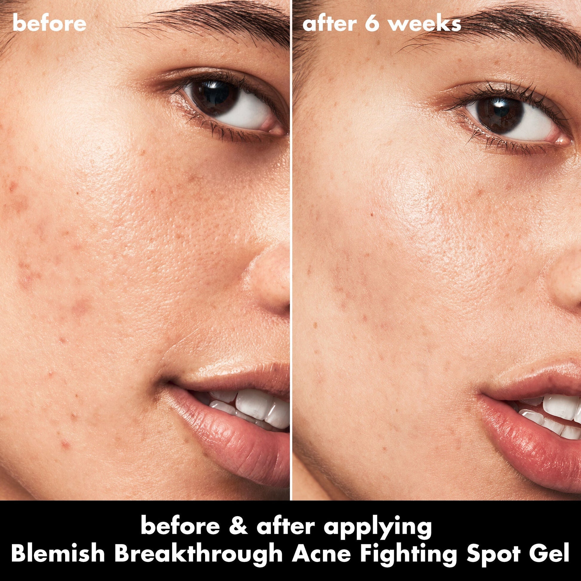 blemish-breakthrough-acne-fighting-spot-gel-a2 0326_EDU_BB_SpotGel_BA_ISABELLA.jpg