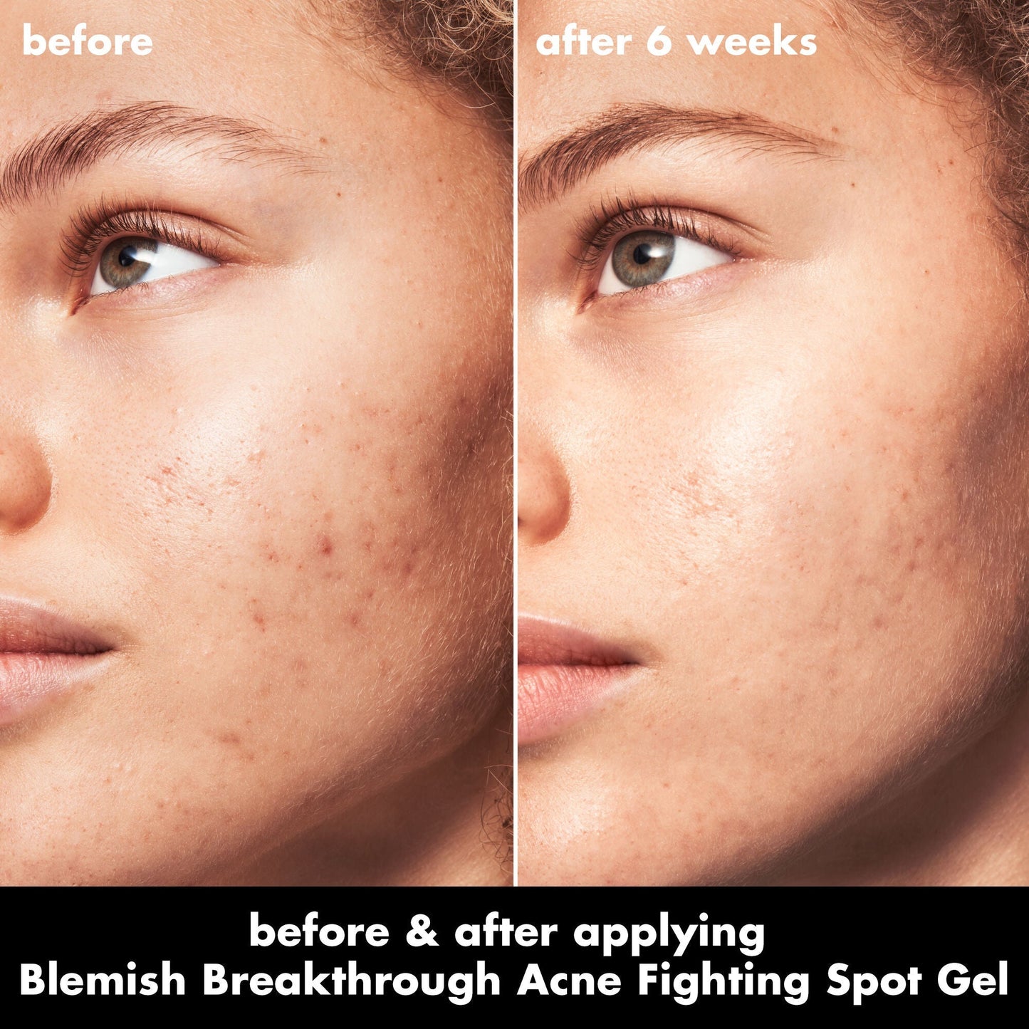 blemish-breakthrough-acne-fighting-spot-gel-a2 0326_EDU_BB_SpotGel_BA_MARLEY.jpg