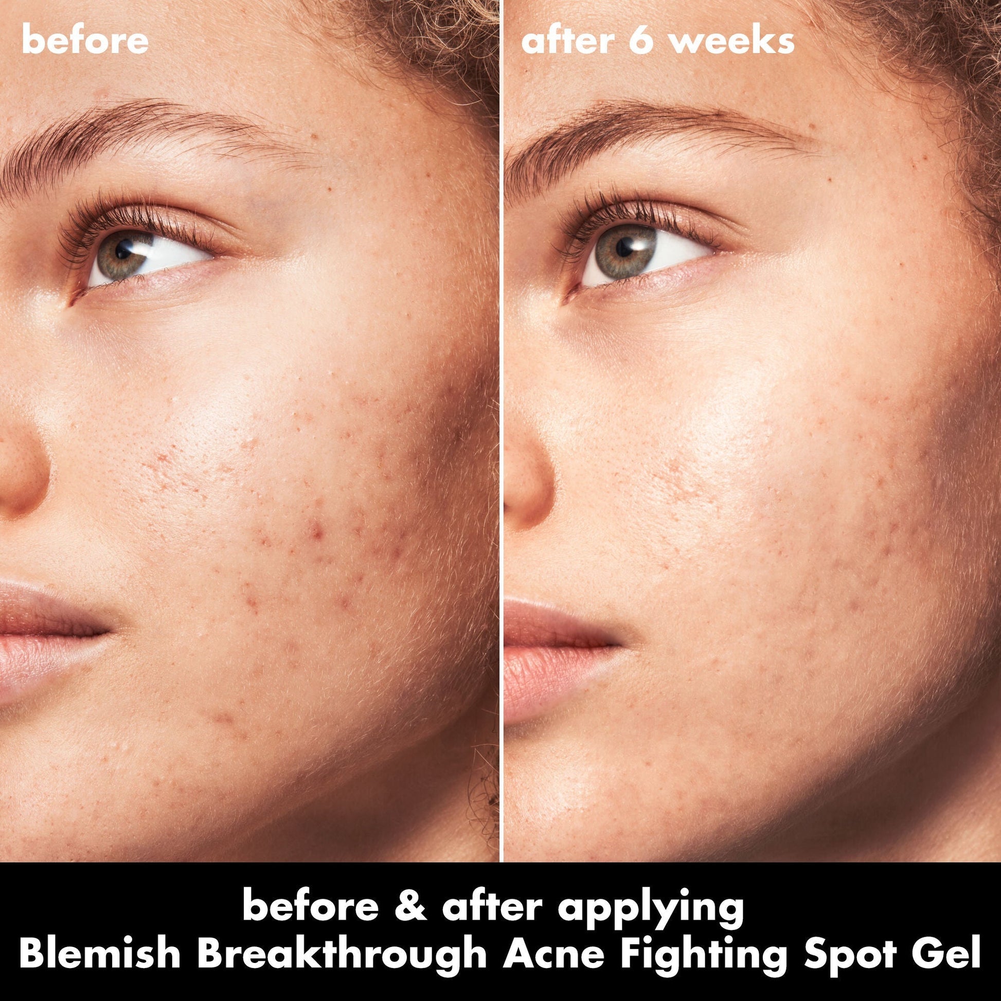 blemish-breakthrough-acne-fighting-spot-gel-a2 0326_EDU_BB_SpotGel_BA_MARLEY.jpg