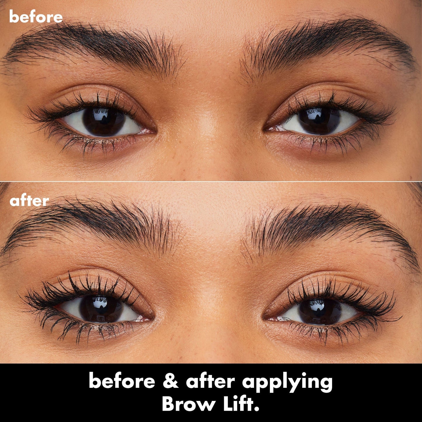 brow-lift-s4 0326_EDU_BrowLift_BA.jpg