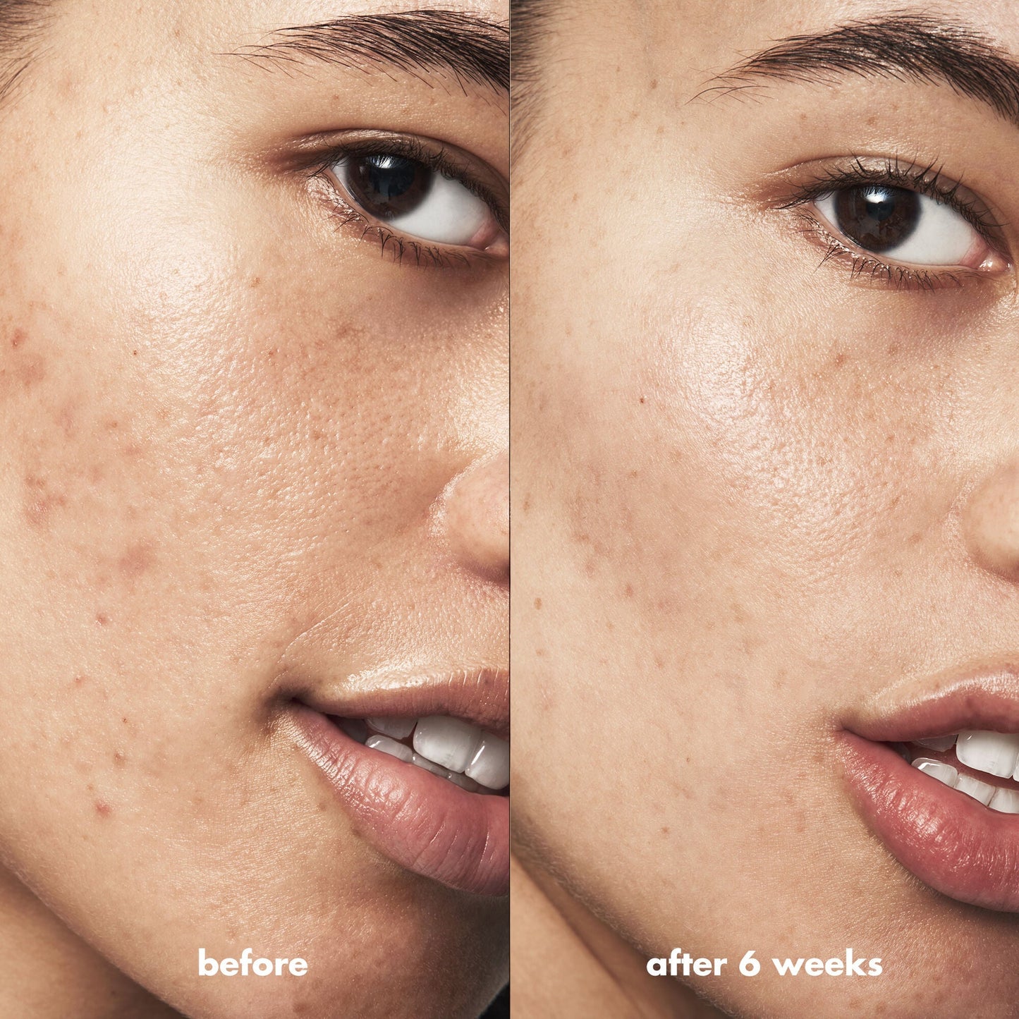 blemish-breakthrough-acne-calming-water-cream-f2 Acne_PDP_Isabella_Before_After_84ce713a-22d2-4bb9-aad7-445c7b27b1c9.jpg