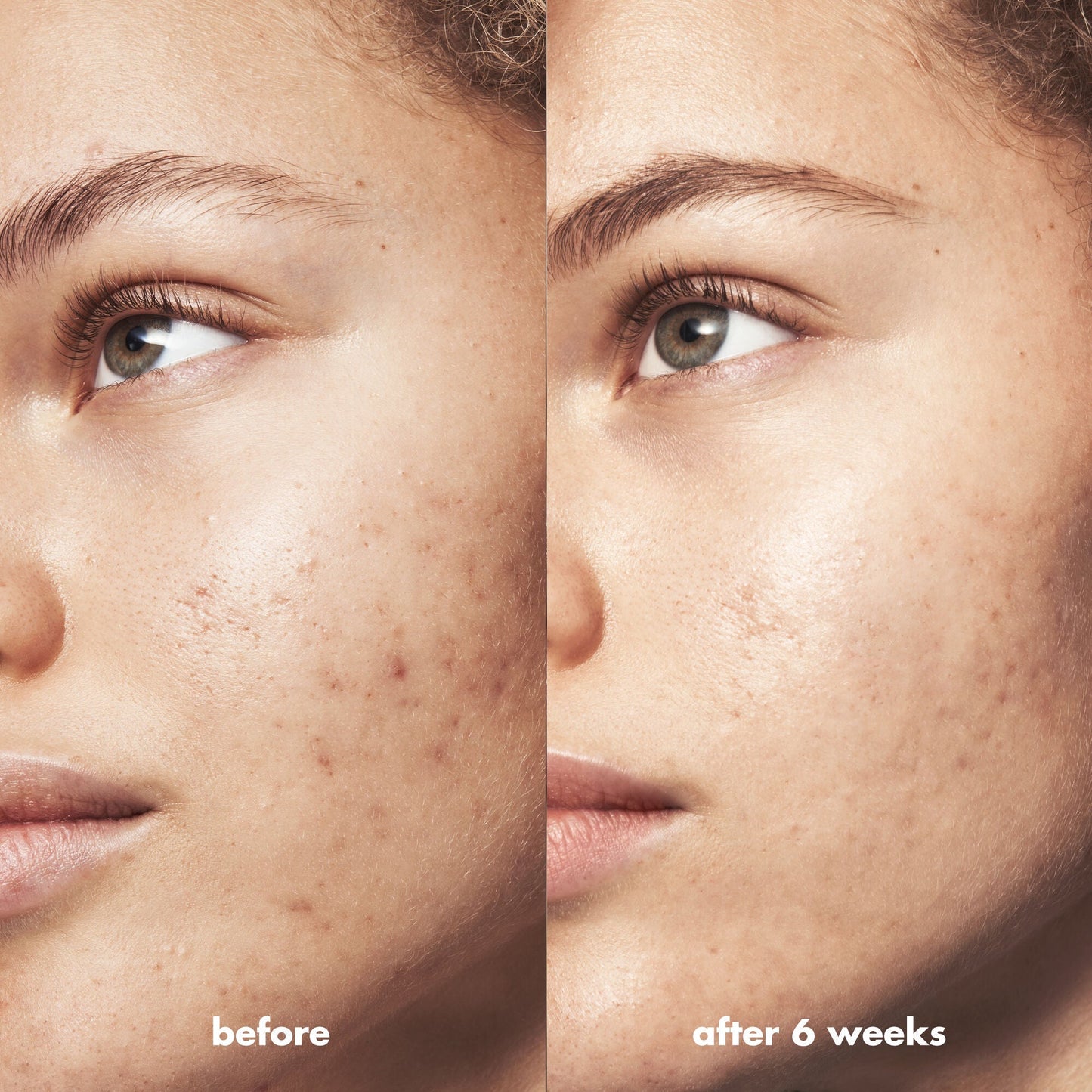 blemish-breakthrough-acne-clarifying-cleanser-h0 Acne_PDP_Marley_Before_After_216490cc-567c-424e-91eb-5374368f15d6.jpg